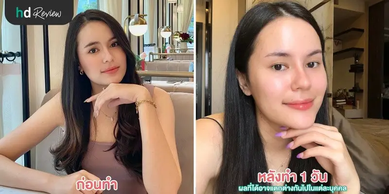 รีวิวฉีด Botulinum Toxin Signature Divine Lift ที่ Divine Clinic