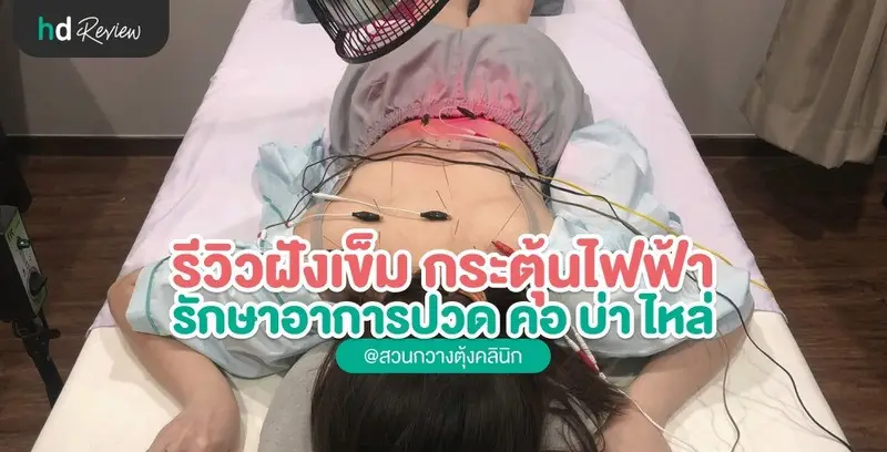 รีวิวฝังเข็มกระตุ้นไฟฟ้า แก้ออฟฟิศซินโดรม ที่ สวนกวางตุ้งคลินิก