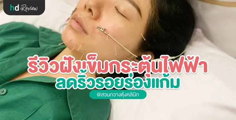 รีวิว ฝังเข็มกระตุ้นไฟฟ้า ลดริ้วรอยร่องแก้ม ที่ สวนกวางตุ้งคลินิก
