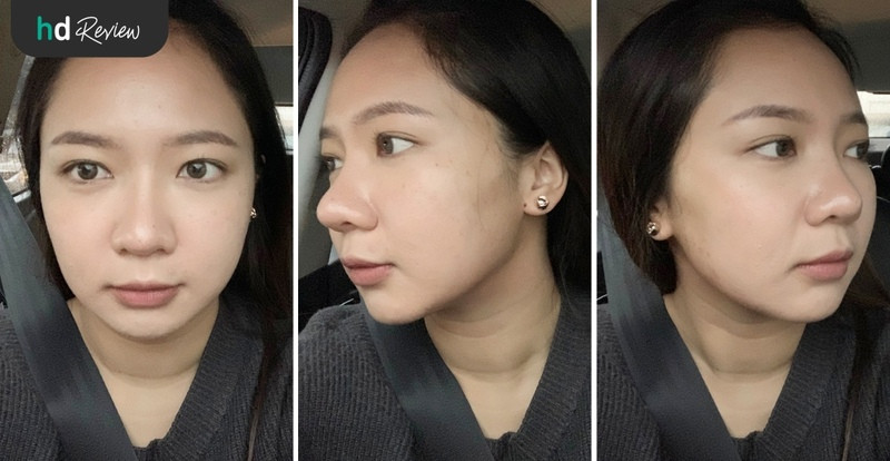 รีวิวฉีด Botulinum Toxin ลิฟท์กรอบหน้า ที่ LV Aesthetic By Dr.Lucy