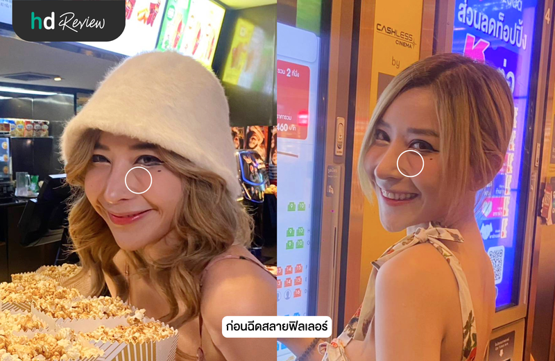 รีวิว โปรแกรมฉีดสลายฟิลเลอร์ใต้ตา ที่ Aki Clinic