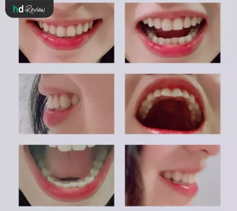 รีวิว จัดฟันใส Dr Clear Aligners โดยแมงมุม สตรอว์เบอรีชีสเค้ก
