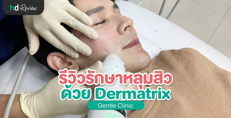 รีวิว รักษาหลุมสิว ด้วย Dermatrix ที่ Gentle Clinic