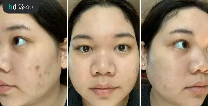 รีวิวเลเซอร์หน้าใส ลดรอยสิว Dual Yellow Laser ที่ Proderma Aesthetic Clinics