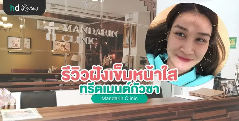 รีวิว ฝังเข็มหน้าใส โดยคนกลัวเข็ม ที่ Mandarin Clinic