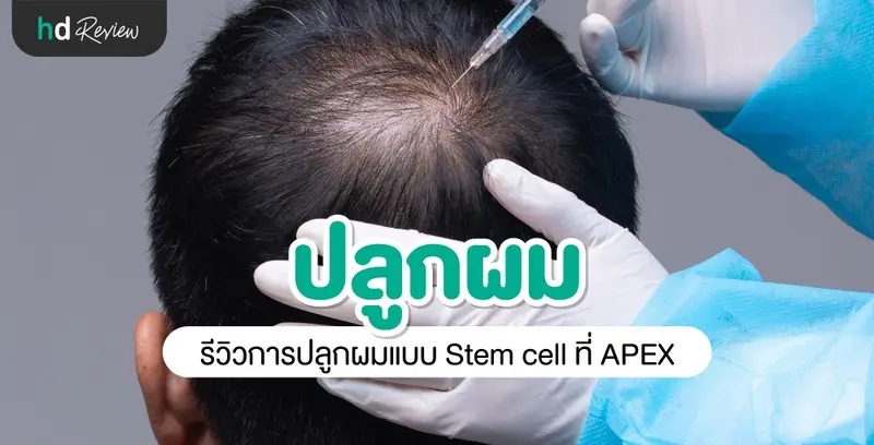 รีวิวการปลูกผมแบบ Hair stem micro transplant ที่ APEX Medical Center