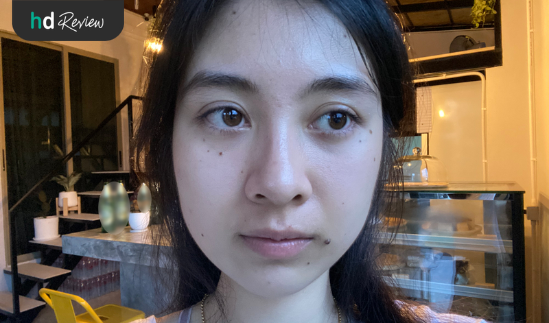 รีวิวโปรแกรมฉีดฟิลเลอร์ใต้ตา Neuramis แก้ปัญหาใต้ตาแพนด้า ที่ Cher Clinic