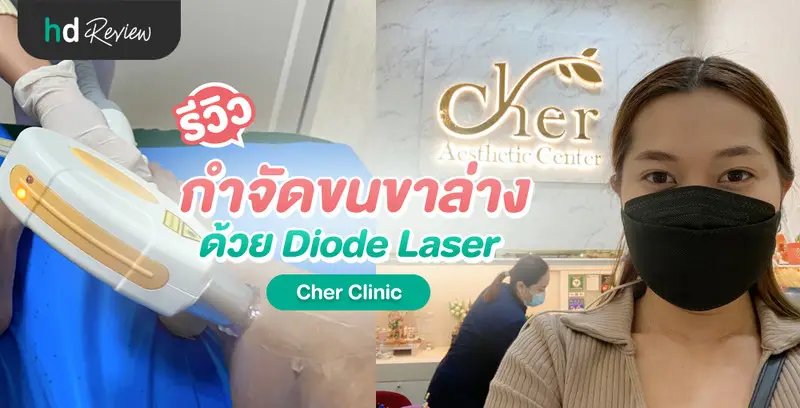 รีวิว กำจัดขนขาล่าง ด้วย Diode Laser ที่ Cher Clinic