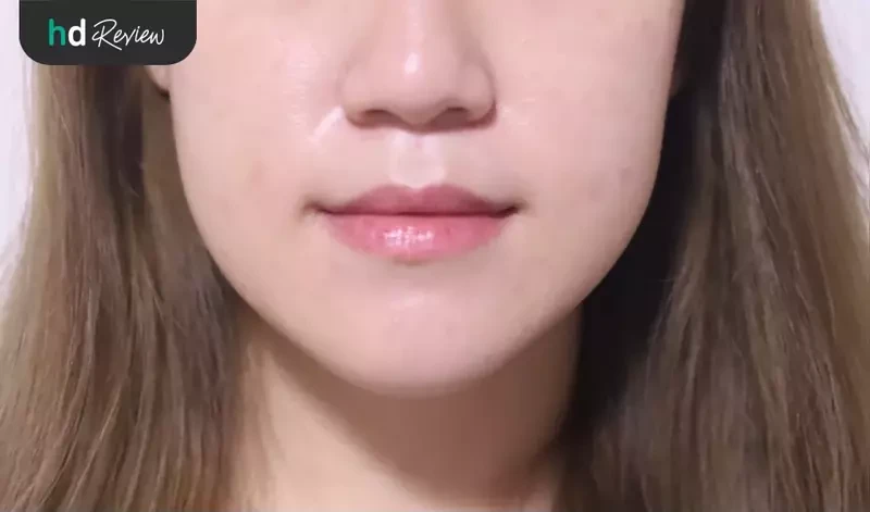 รีวิว ฉีดฟิลเลอร์ปาก แก้ปัญหาปากแบน ที่ La Grace Clinic