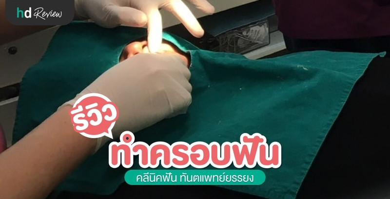 รีวิว ประสบการณ์ฟันแตก แก้ด้วยการครอบฟัน ที่ คลีนิคฟัน ทันตแพทย์ยรรยง