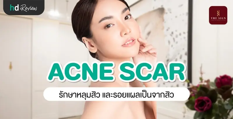 รีวิว PicoWay Acne Scar รักษาหลุมสิวและรอยแผลเป็นจากสิว ที่เดอะไซน์ คลินิก (The Sign Clinic)