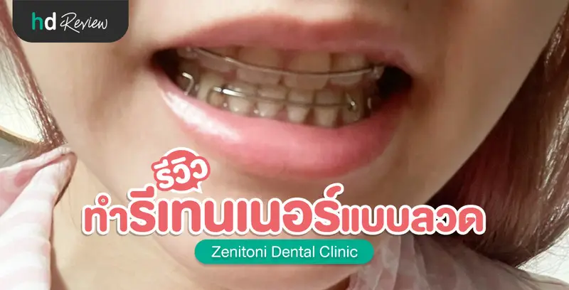 รีวิว ทำรีเทนเนอร์แบบลวด ที่ Zenitoni Dental Clinic