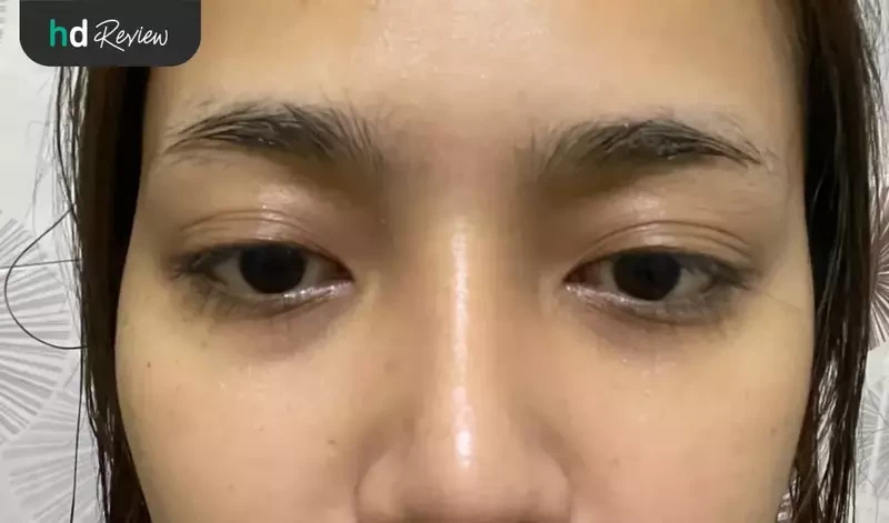 รีวิว ฉีดฟิลเลอร์ใต้ตา แก้ปัญหาใต้ตาคล้ำ ที่ La Grace Clinic