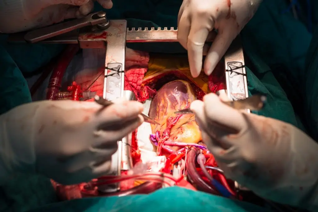 การผ่าตัดทำทางเบี่ยงหลอดเลือดหัวใจ (Coronary Artery Bypass Grafting: CABG)