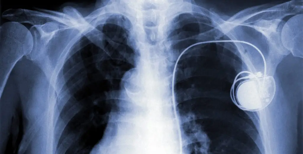 การใส่เครื่องกระตุ้นไฟฟ้าหัวใจ (Pacemaker Implantation)