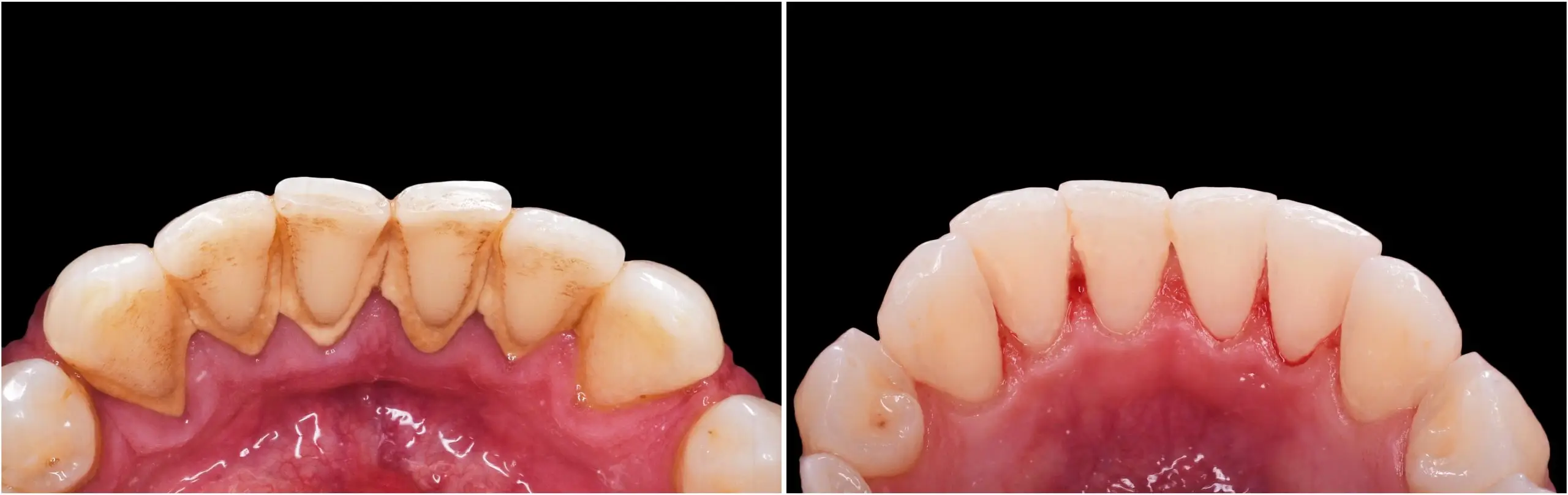 9 คำถามยอดฮิตของการฟอกฟัน คนอยากฟอกสีฟันต้องอ่าน scaled