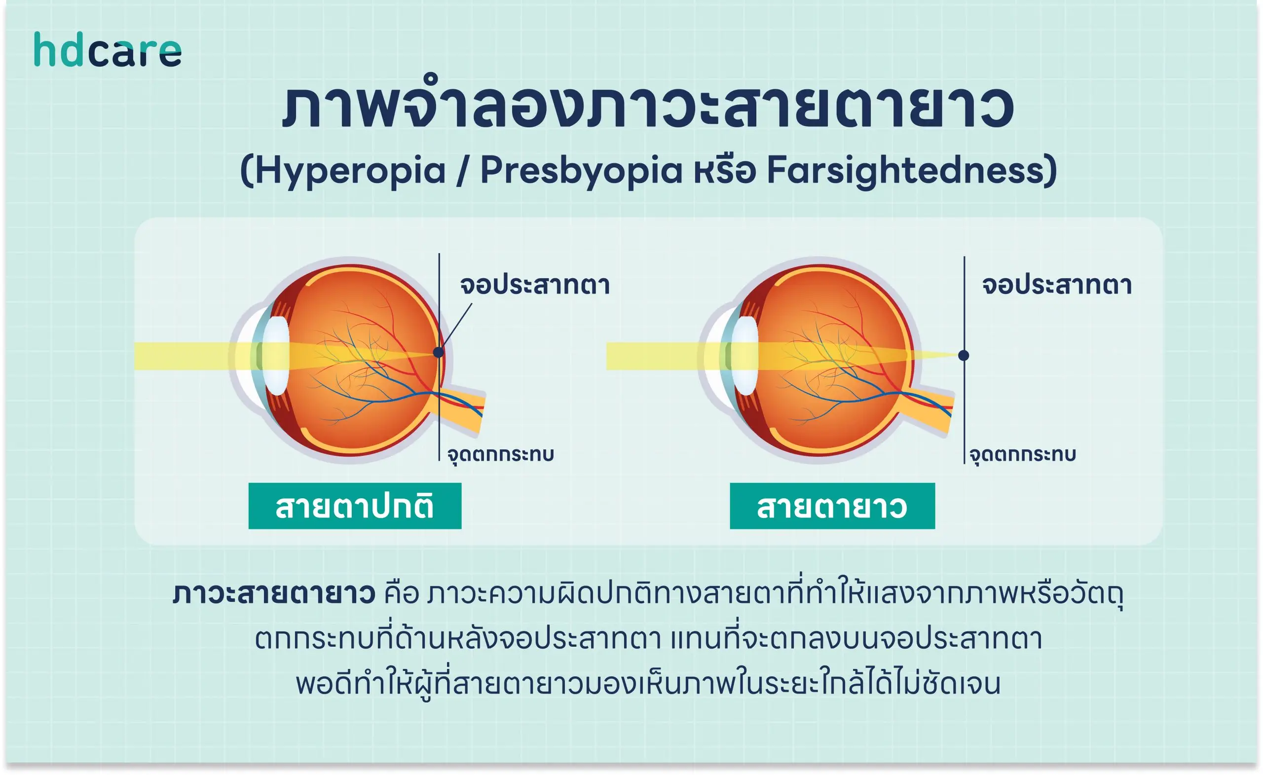 HDcare content สายตายาว 2 scaled