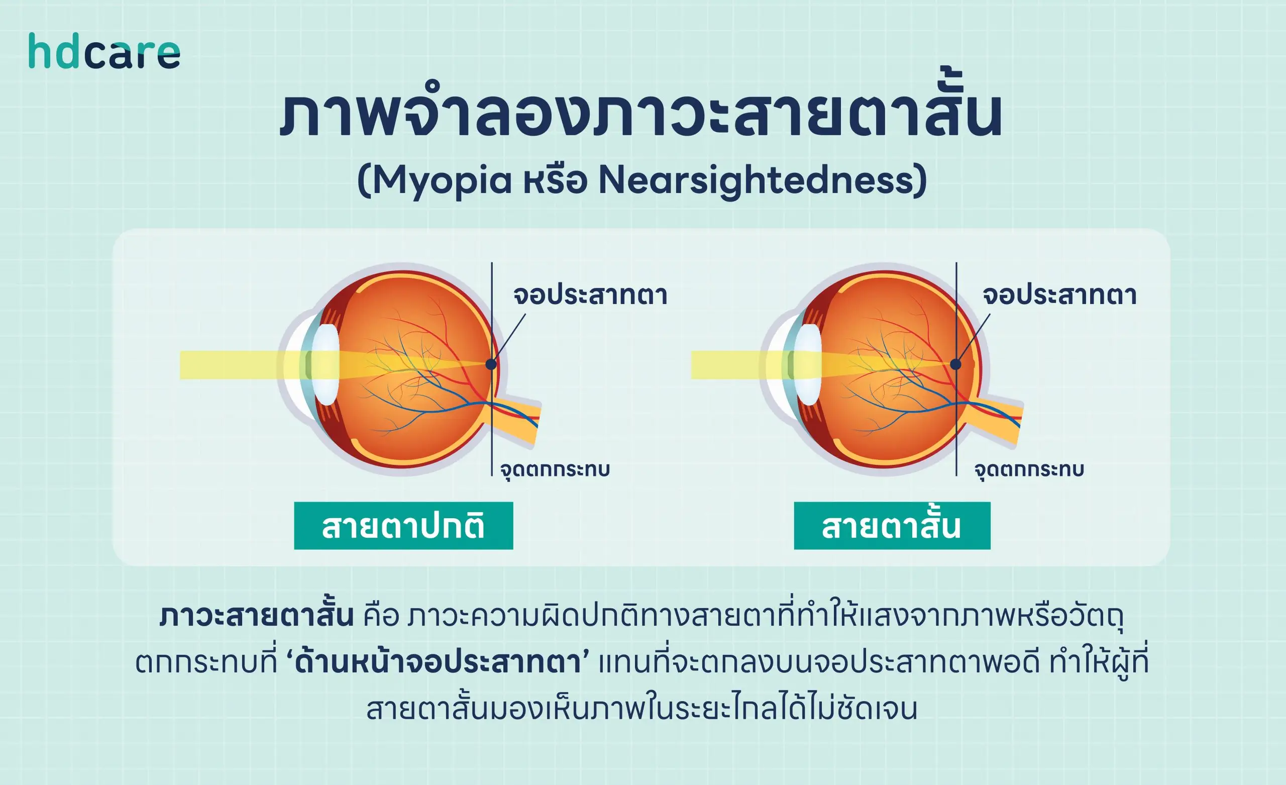 ภาพจำลองภาวะสายตาสั้น