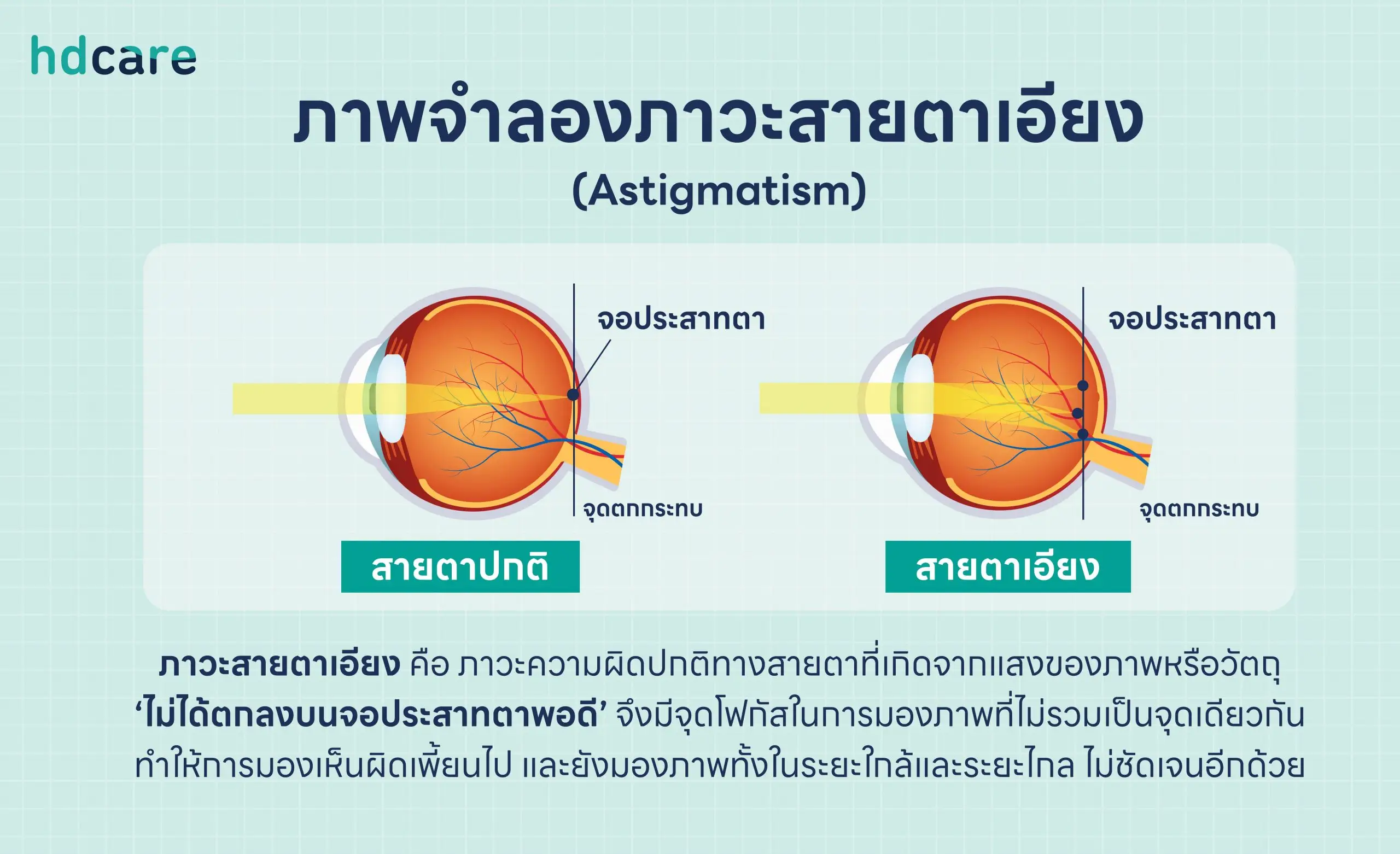 ภาพจำลองภาวะสายตาเอียง