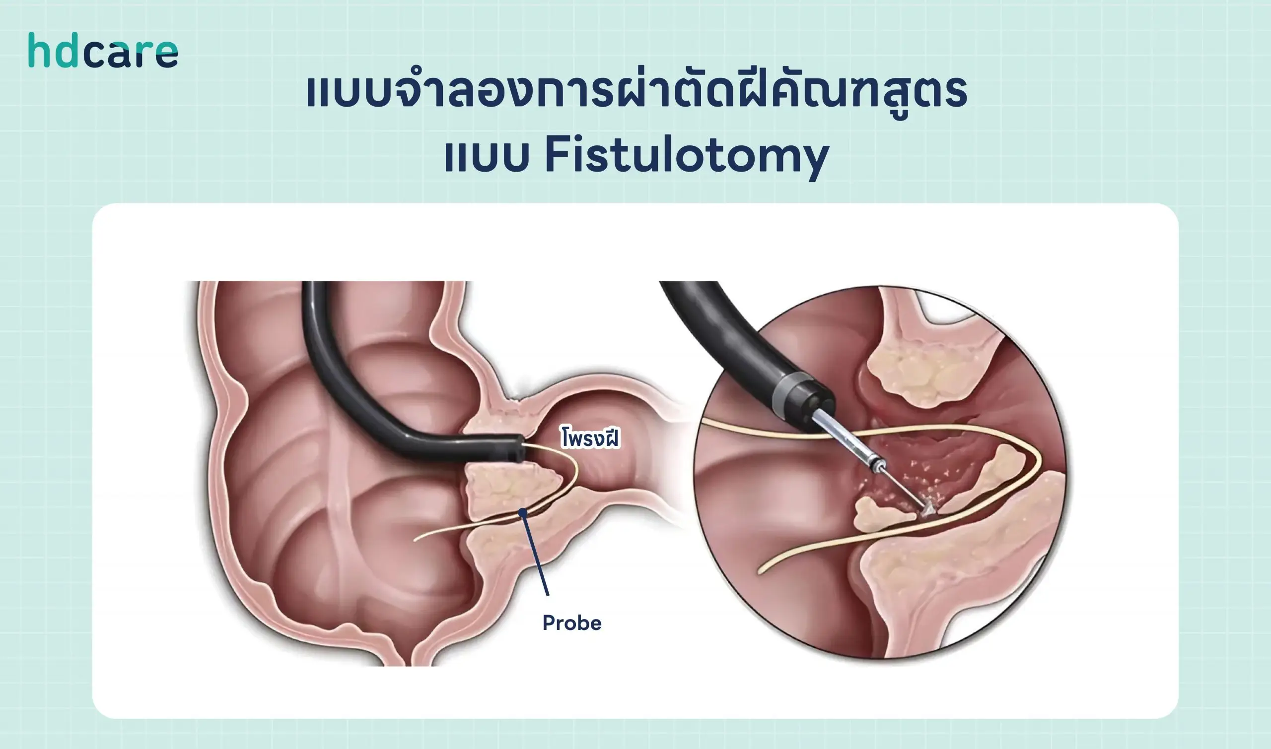 แบบจำลองการผ่าตัดฝีคัณฑสูตรแบบ-Fistulotomy