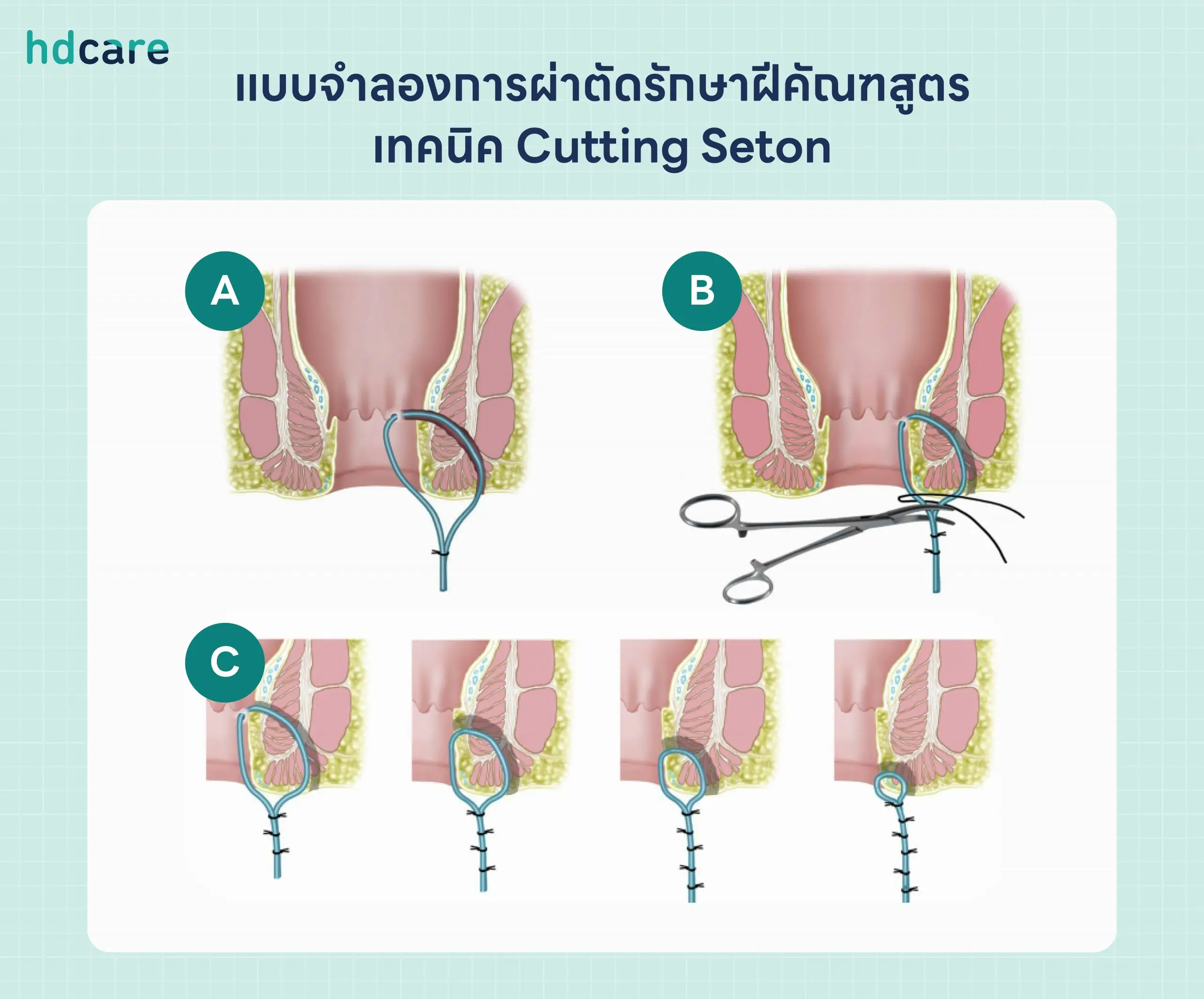 แบบจำลองการผ่าตัดรักษาฝีคัณฑสูตรเทคนิค-Cutting-Seton