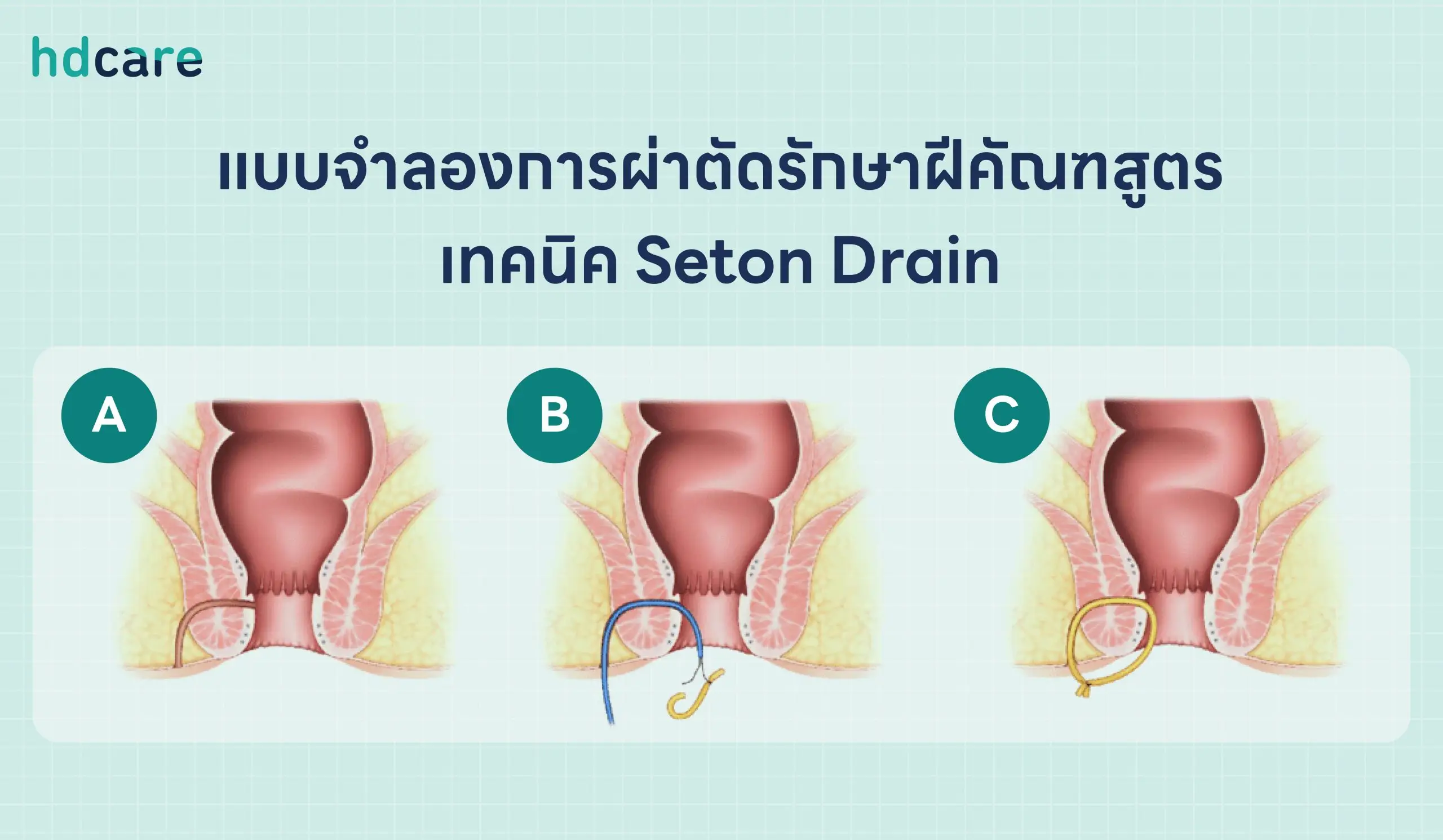 แบบจำลองการผ่าตัดรักษาฝีคัณฑสูตรเทคนิค-Seton-Drain