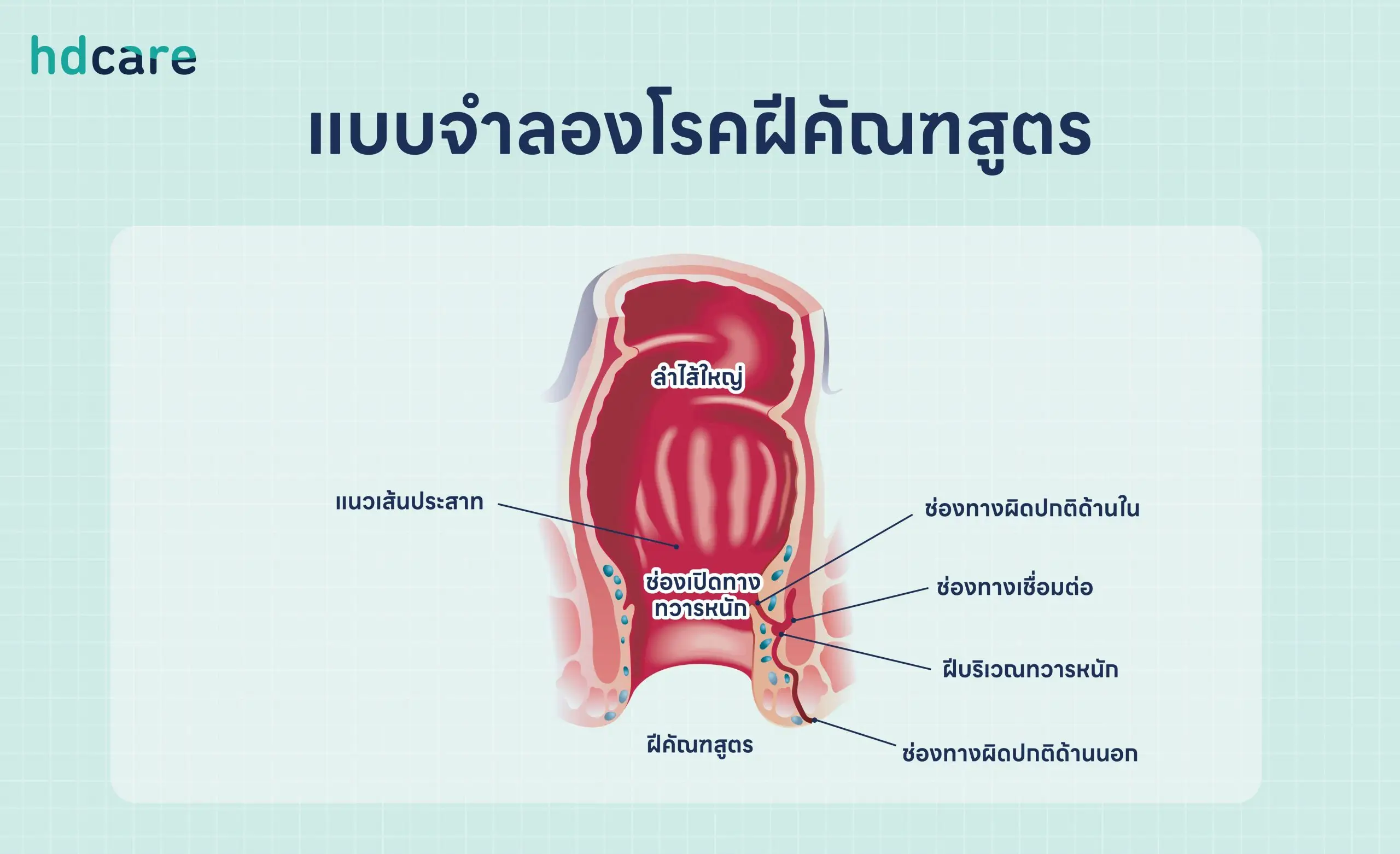 แบบจำลองโรคฝีคัณฑสูตร