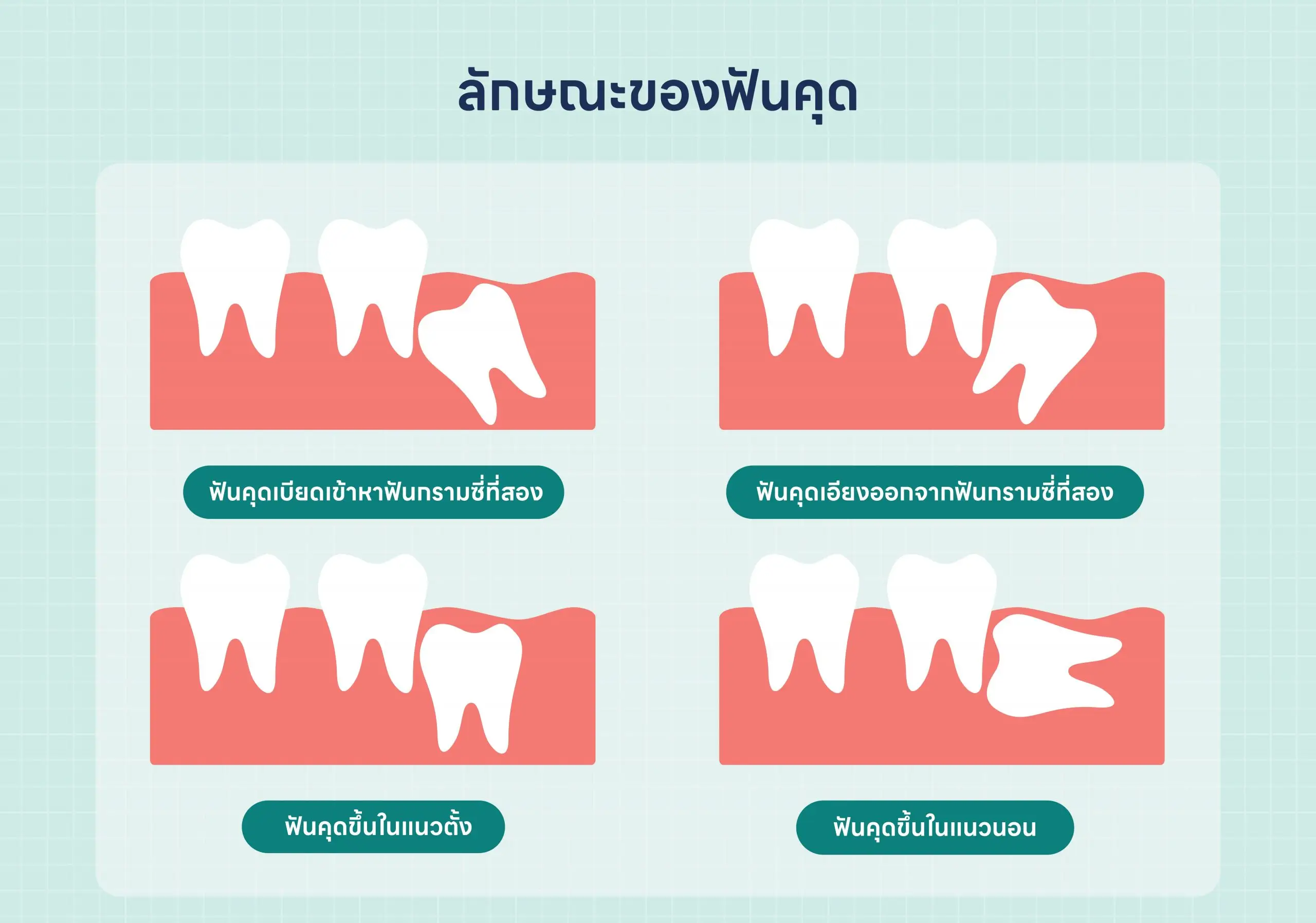 HDmall Blog ลักษณะของฟันคุด 2 scaled