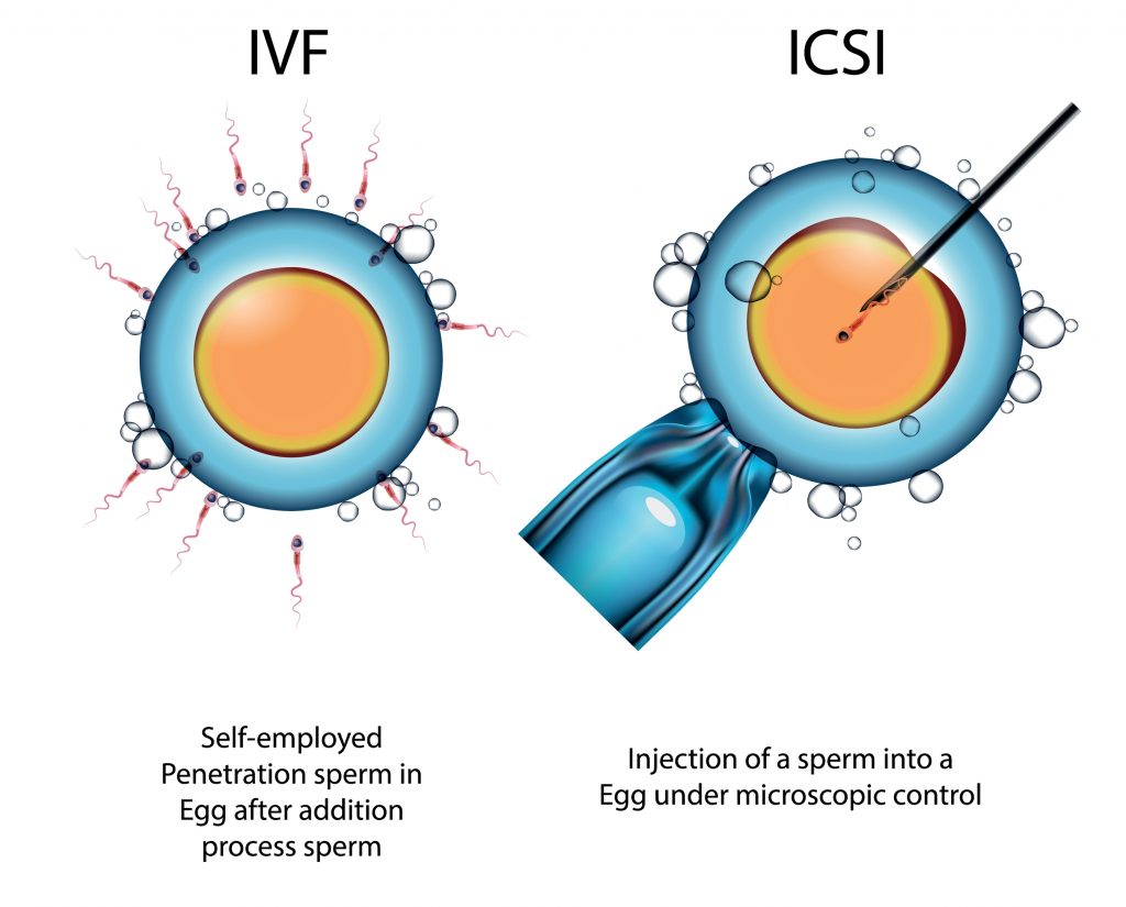 ICSI คืออะไร มีขั้นตอนอย่างไร ข้อดี-ข้อจำกัด ราคาเท่าไหร่?