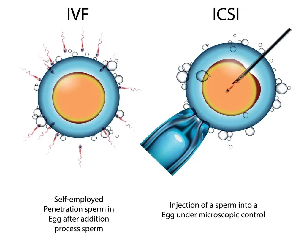 ICSI คืออะไร มีขั้นตอนอย่างไร ข้อดี-ข้อจำกัด ราคาเท่าไหร่?