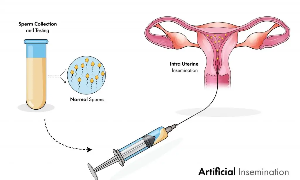 IUI คืออะไร มีขั้นตอนอย่างไร ข้อดี-ข้อจำกัด ราคาเท่าไหร่?