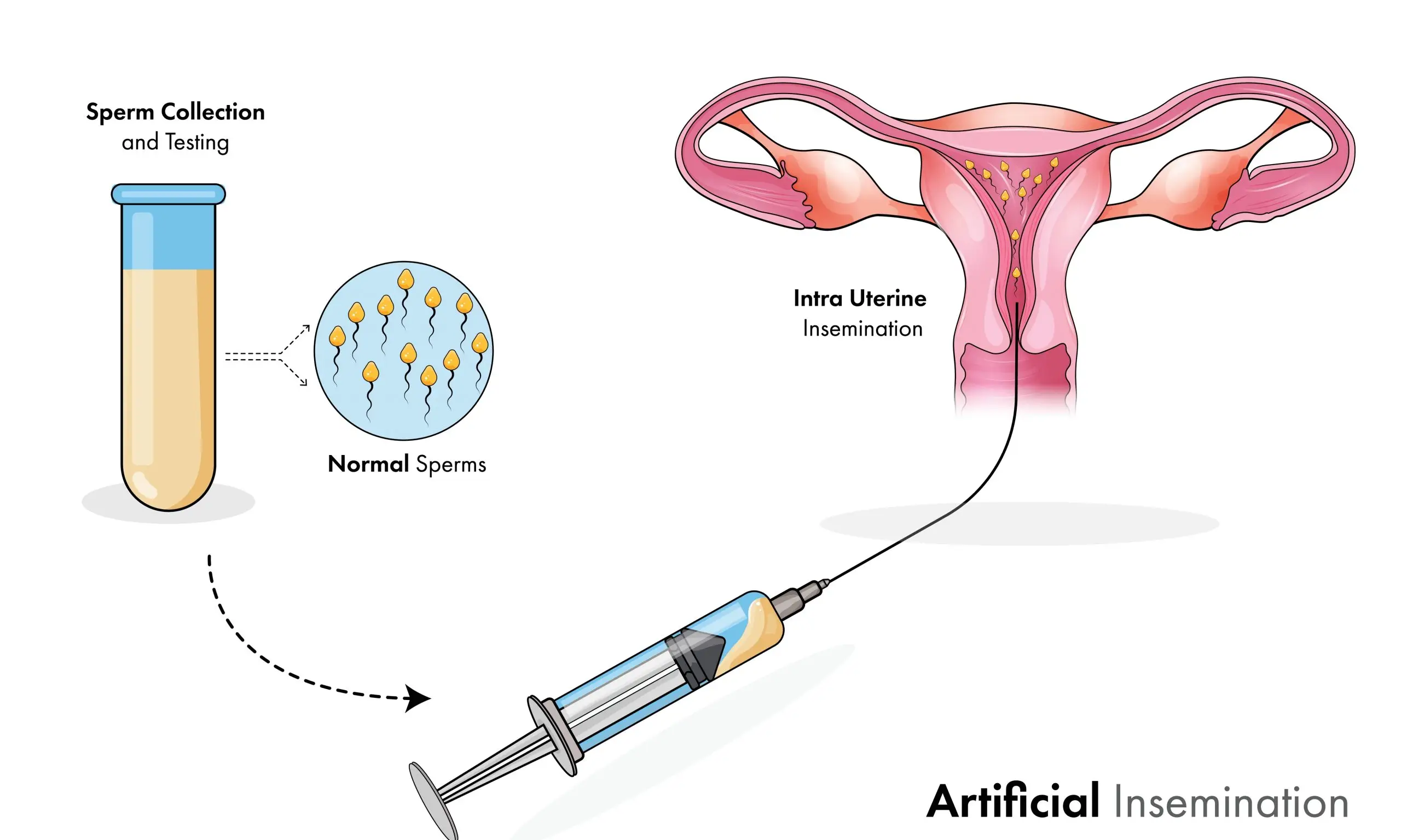 IUI คืออะไร มีขั้นตอนอย่างไร ข้อดี ข้อจำกัด ราคาเท่าไหร่ scaled