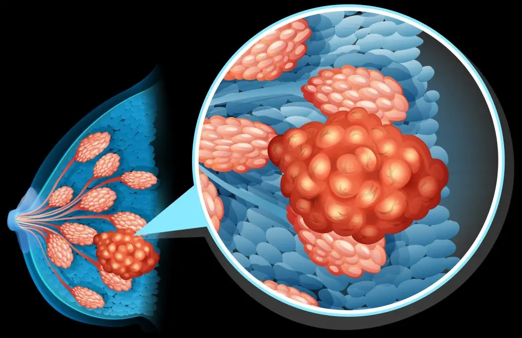 ก้อนที่เต้านม (Breast Lump)