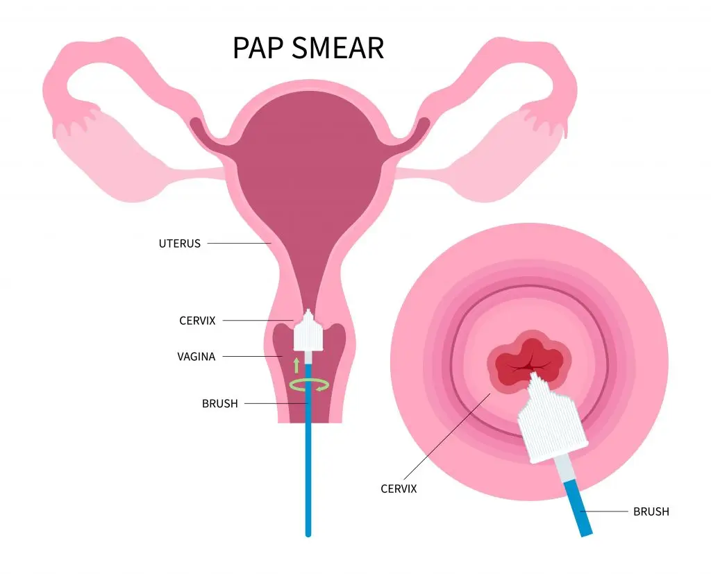 ขั้นตอนการตรวจคัดกรองมะเร็งปากมดลูก