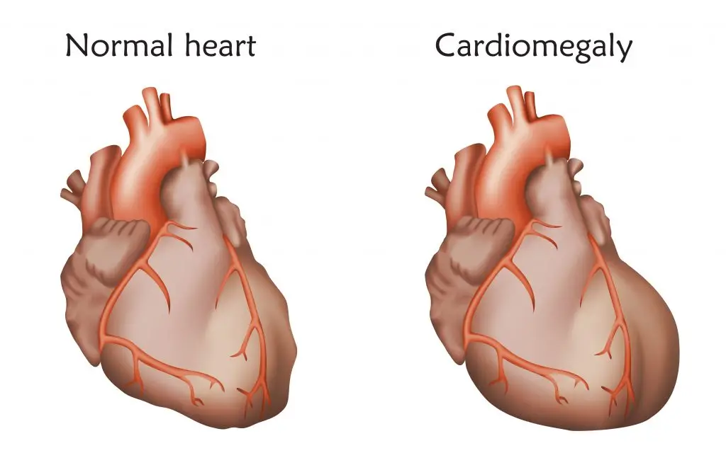 ภาวะหัวใจโตคืออะไร มีสาเหตุเกิดจากอะไร