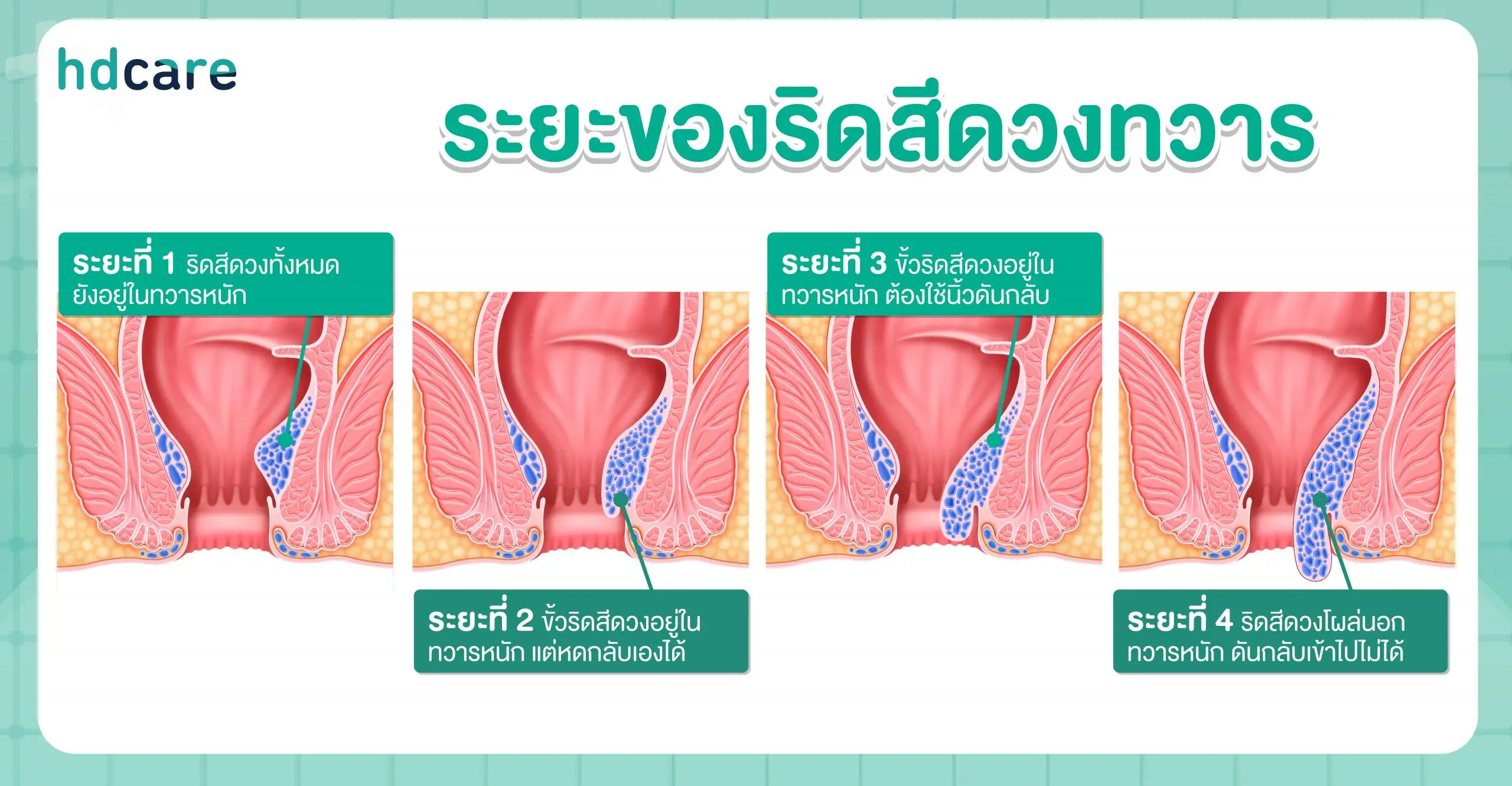 ระยะริดสีดวงทวาร