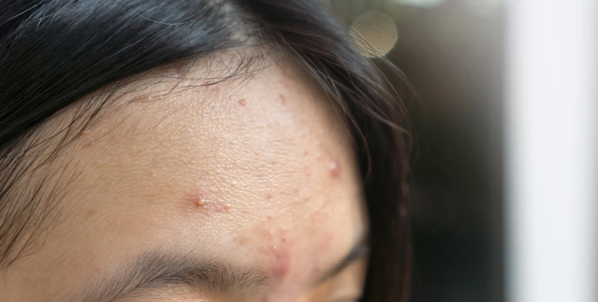 รักษาสิวผด Acne Aestivalis ทำอย่างไรให้ได้ผล