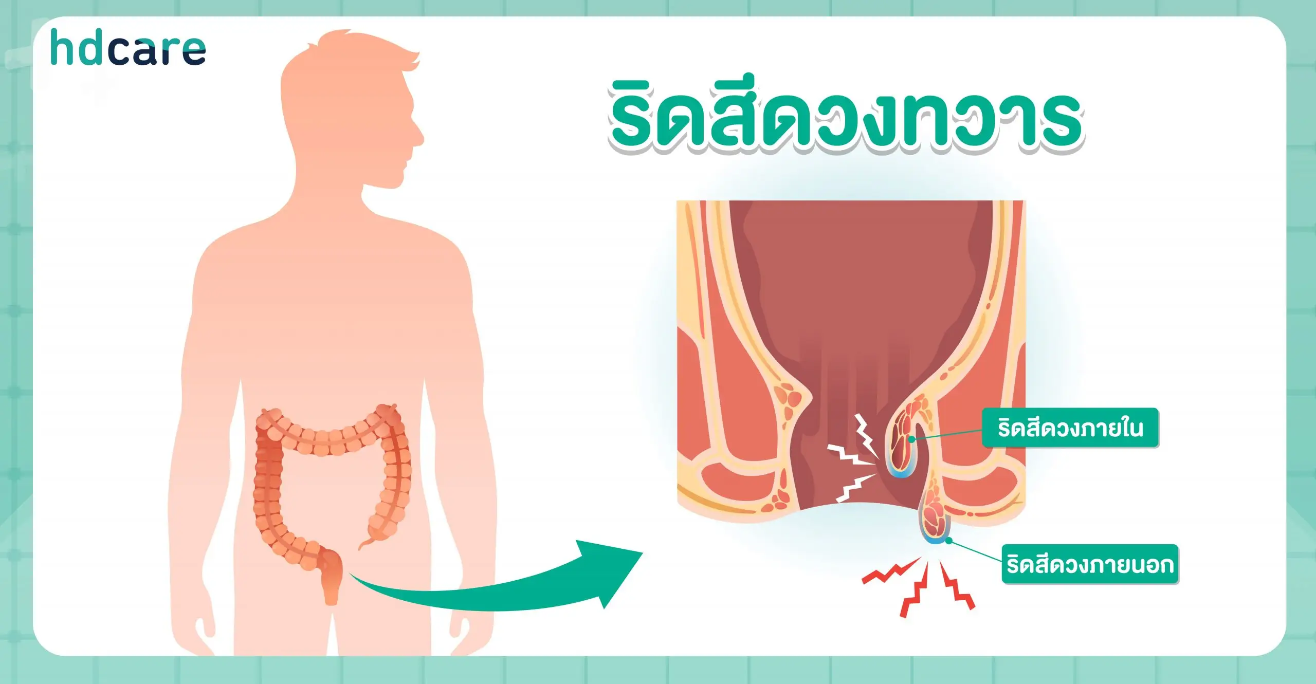 ริดสีดวงทวารภายในและภายนอก