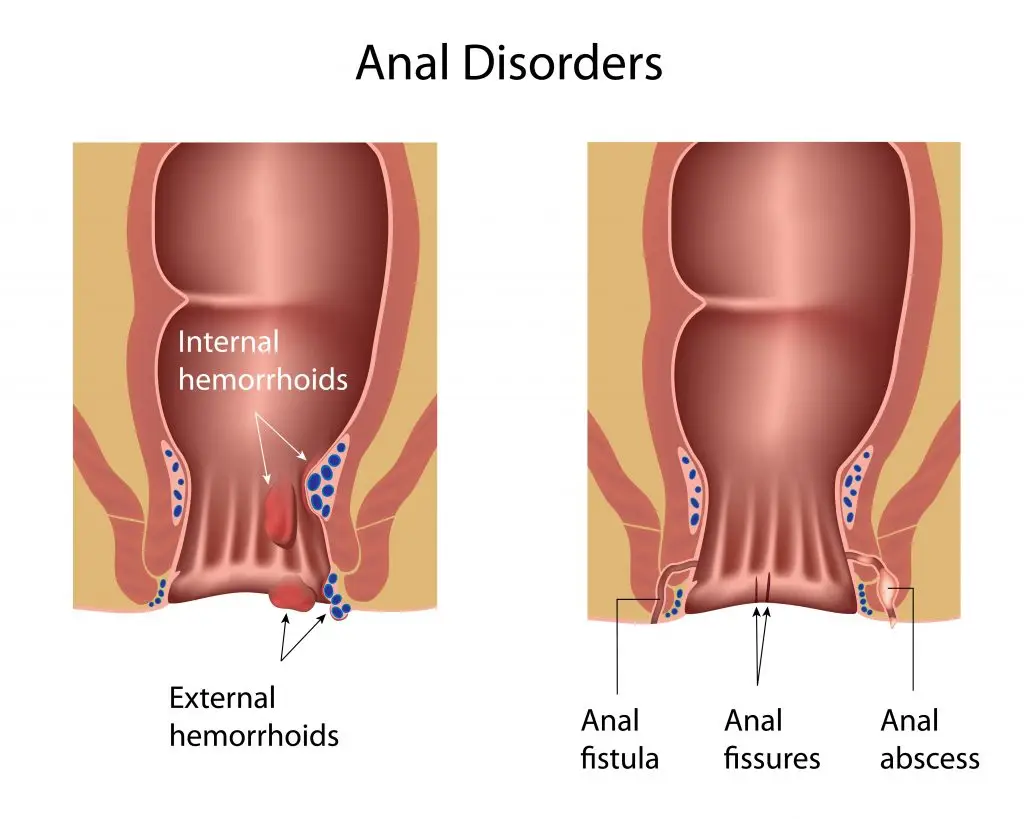 รู้จักฝีคัณฑสูตร สาเหตุ อาการ เป็นแล้วหายเองได้ไหม รักษายังไง?