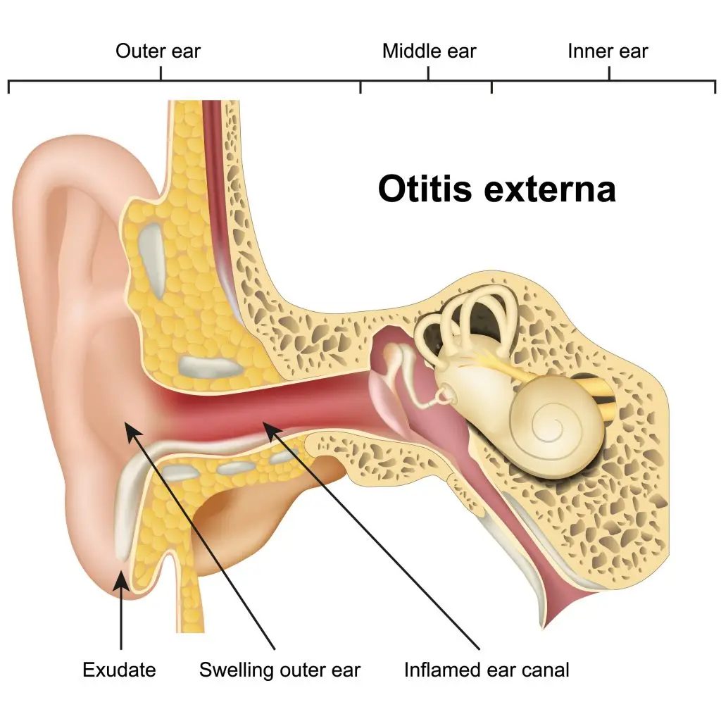 หูชั้นนอกอักเสบ (Otitis Externa)