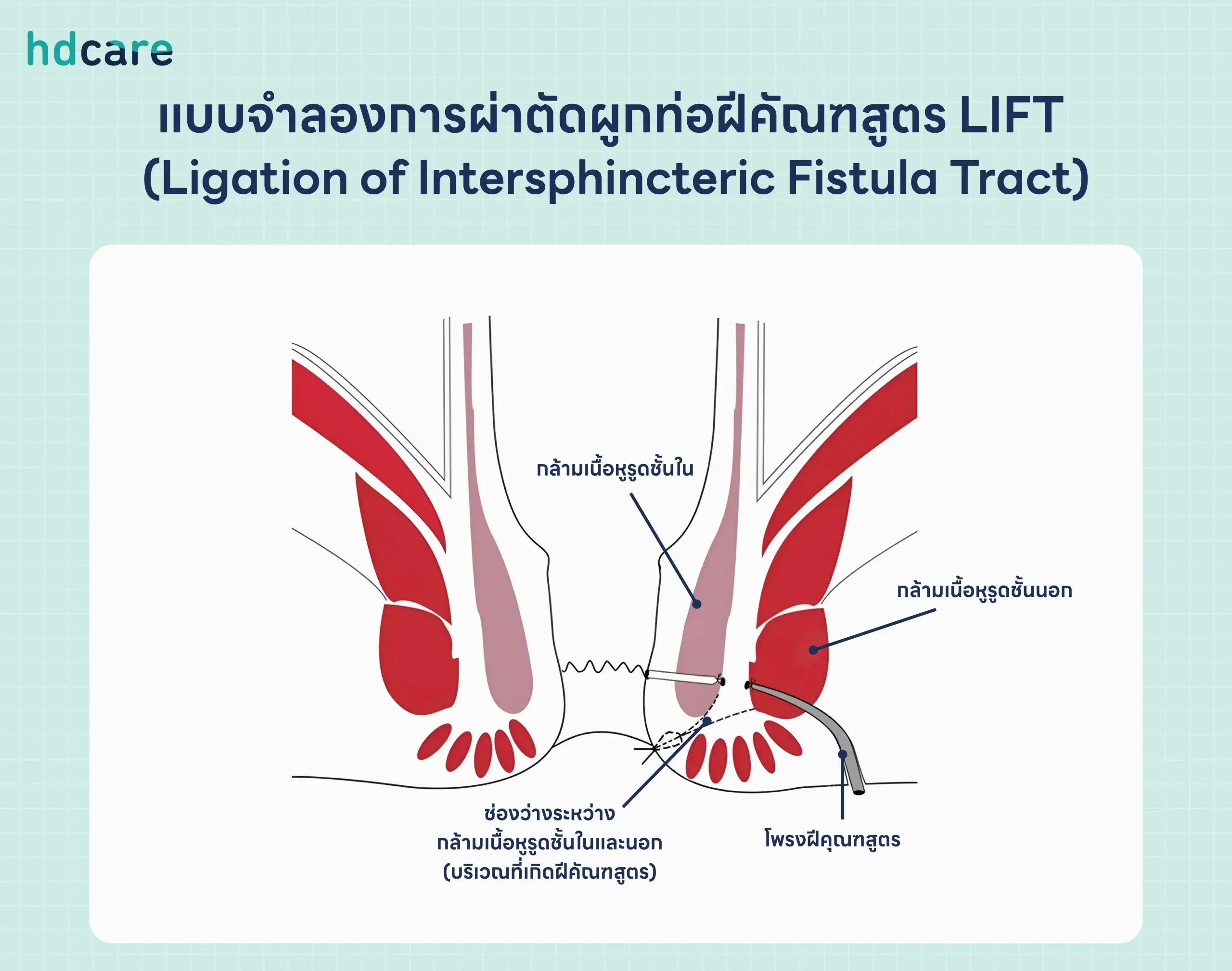 แบบจำลองการผ่าตัดผูกท่อฝีคัณฑสูตร-LIFT-Ligation-of-Intersphincteric-Fistula-Tract