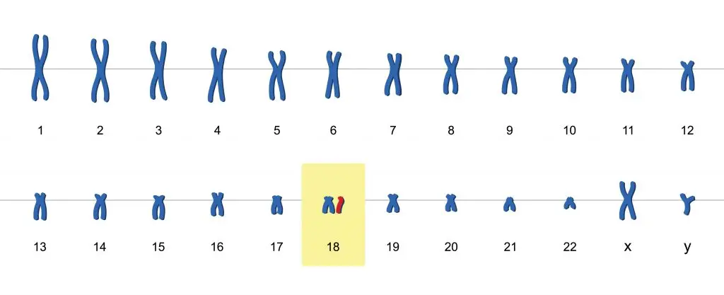 โรค Edwards Syndrome เป็นอย่างไร รักษาได้ไหม