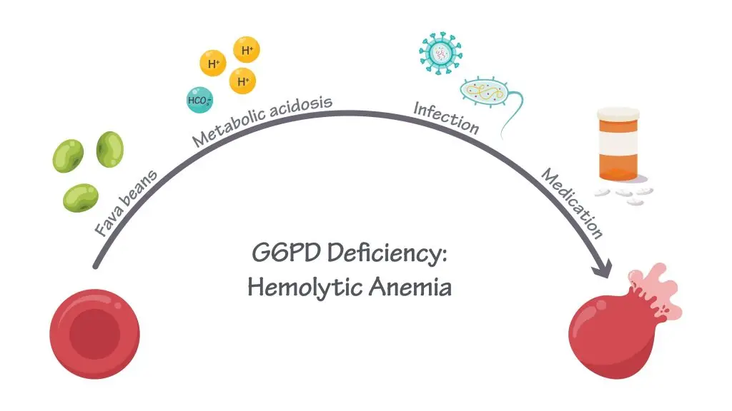 โรค G6PD คืออะไร อาการเป็นอย่างไร