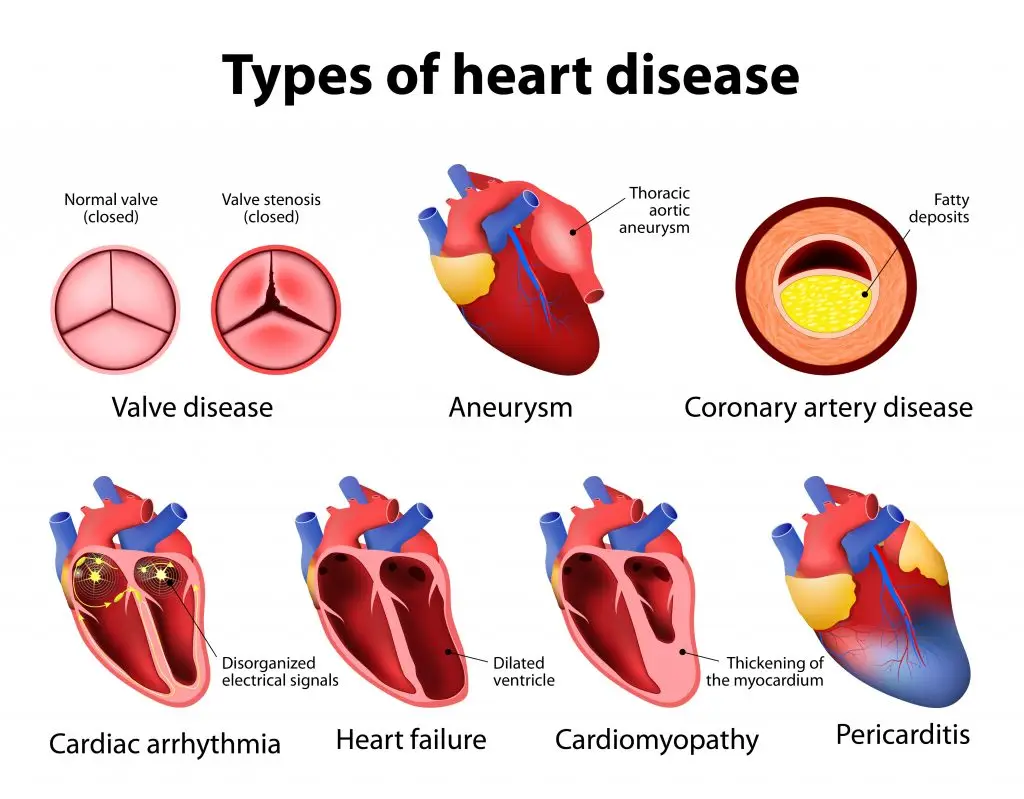 โรคหัวใจทางพันธุกรรม (Inherited Cardiac Conditions)