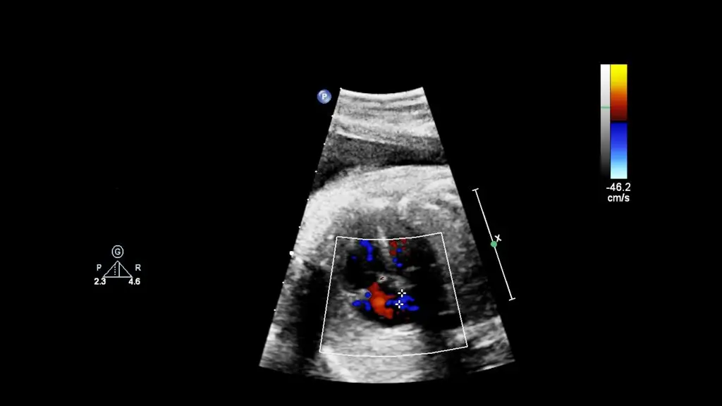 โรคหัวใจพิการแต่กำเนิด (Congenital Heart Disease)