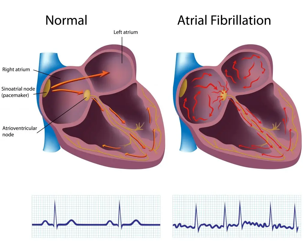 โรคหัวใจเต้นเร็วจากหัวใจห้องบน (Supraventricular Tachycardia)