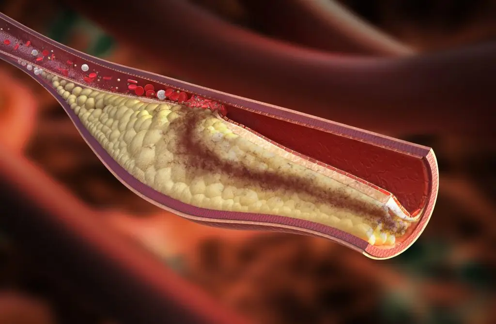 โรคหัวใจและหลอดเลือด (Cardiovascular Disease)