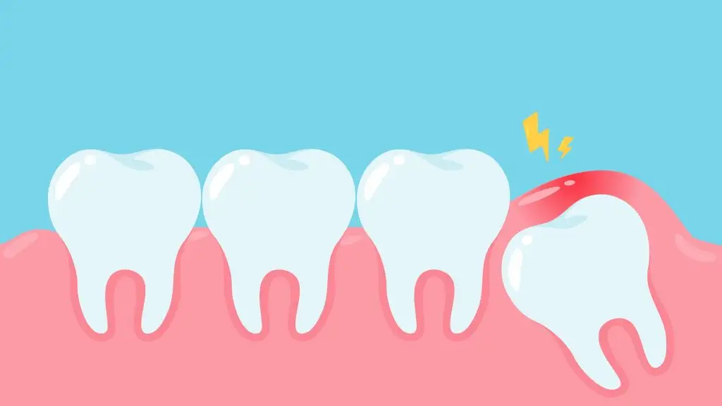 6 เรื่องเข้าใจผิดเกี่ยวกับฟันคุดที่หลายคนไม่รู้