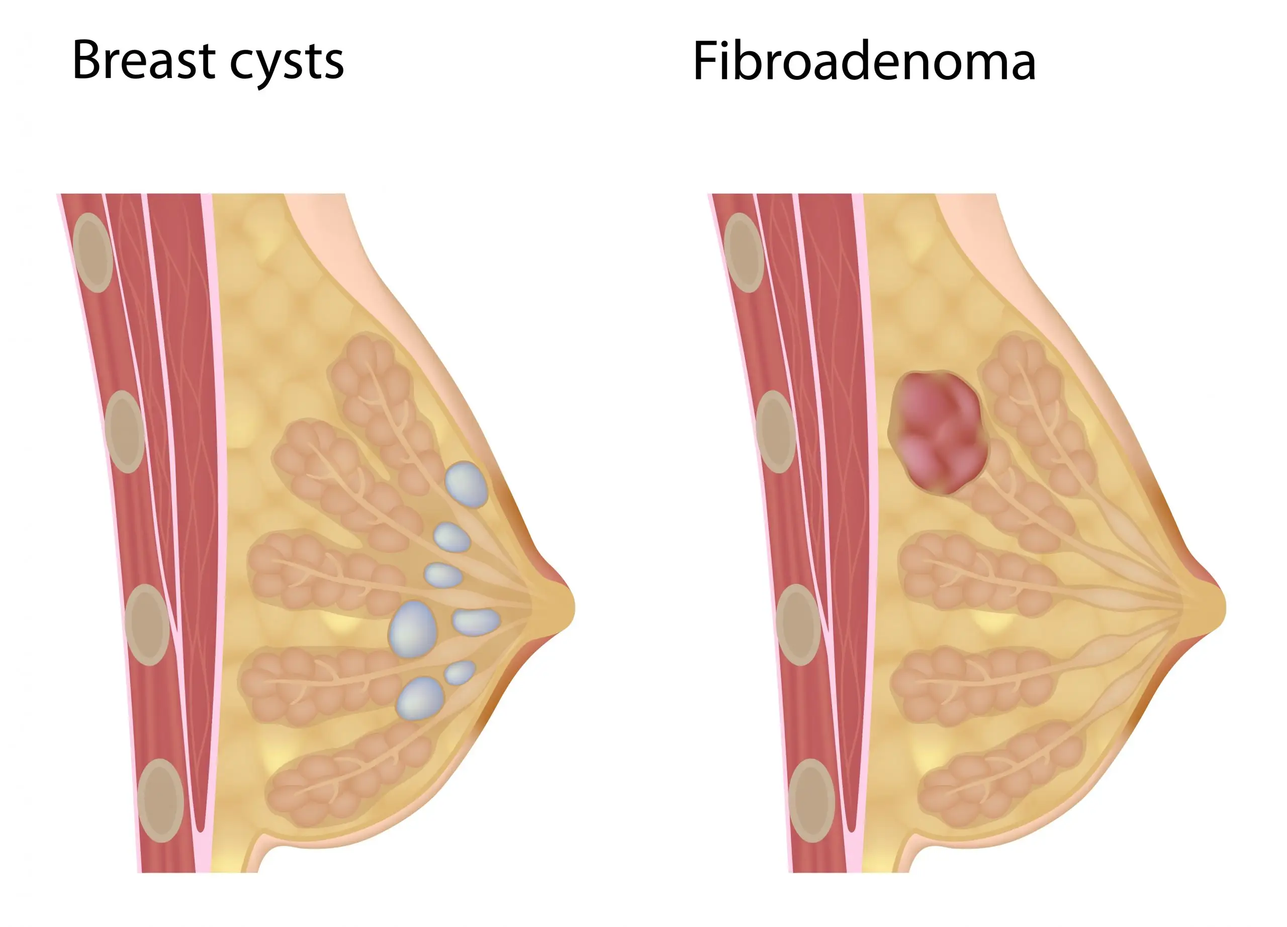 breast lumps and cysts disease comparison scaled