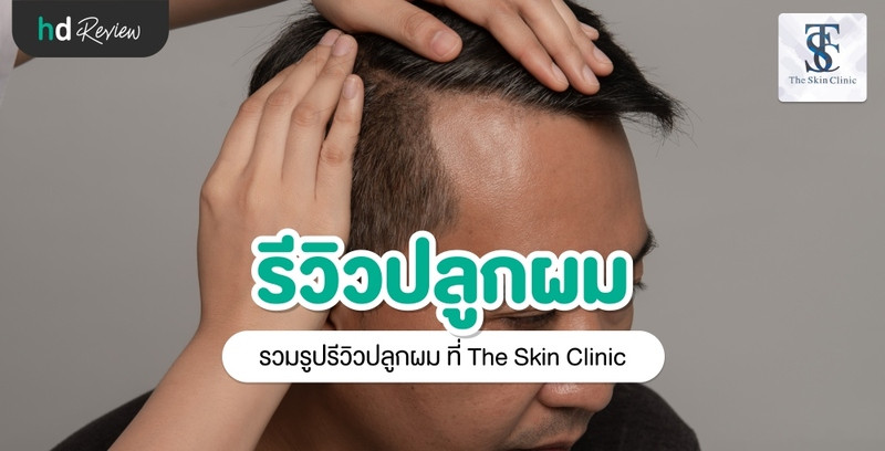 รีวิว ปลูกผมเทคนิคต่างๆ ที่ The Skin Clinic